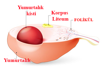 Endometriozis