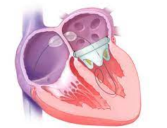 Mitral kapak tamiri