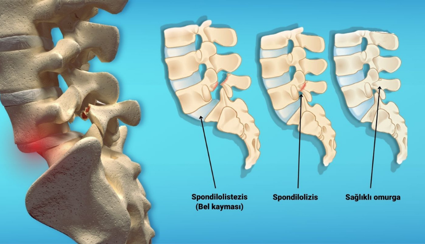 Bel kayması her yaşta görülebilir! Uzmanı uyardı