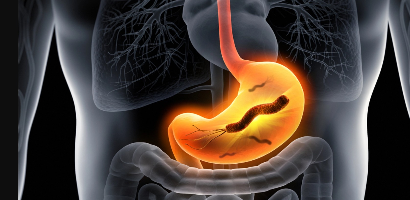 Helicobacter pylori