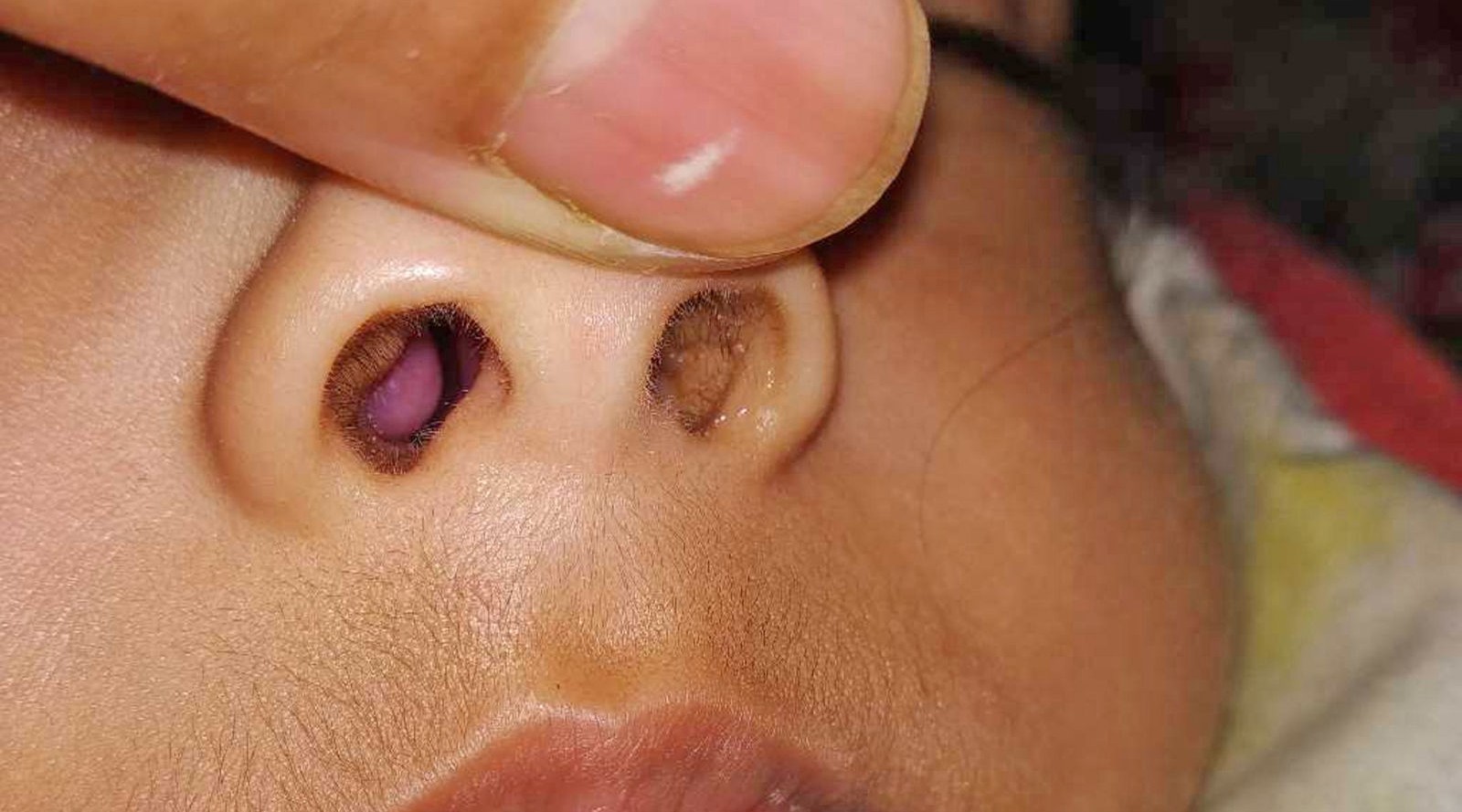 Geniz eti çocuklarda uyku ve yüz gelişimini bozuyor1